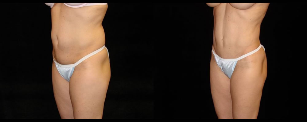 Tummy Tuck Before & After Patient #596