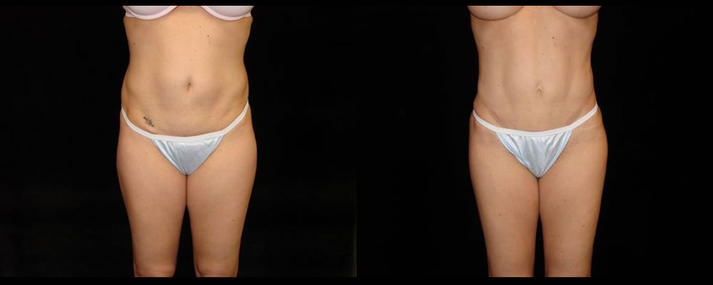 Tummy Tuck Before & After Patient #596