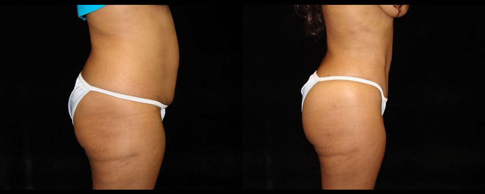 Tummy Tuck Before & After Patient #455