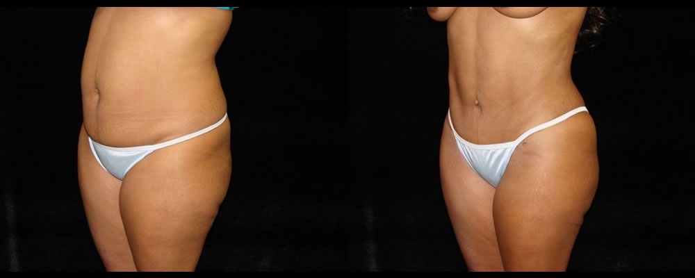 Tummy Tuck Before & After Patient #455
