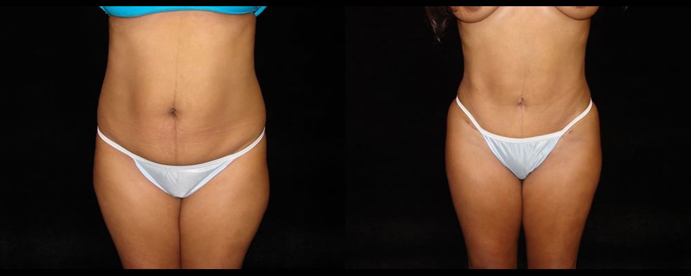 Tummy Tuck Before & After Patient #455