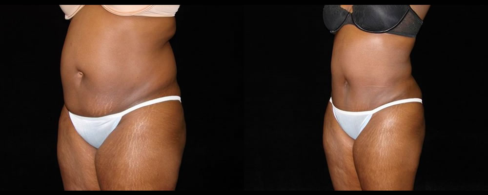 Tummy Tuck Before & After Patient #451