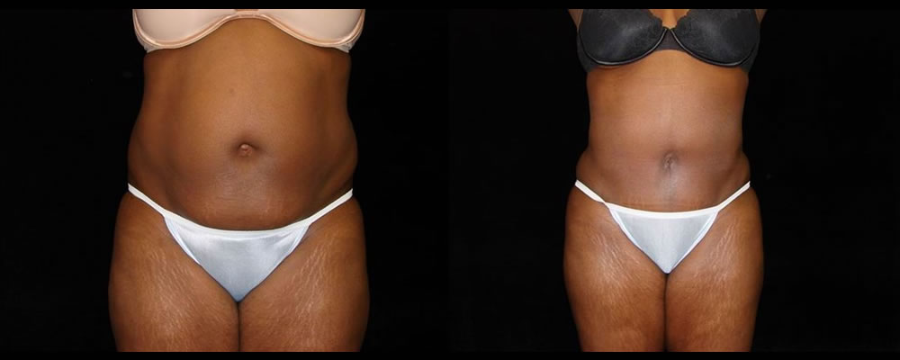 Tummy Tuck Before & After Patient #451