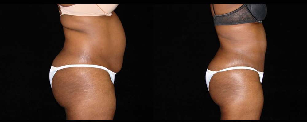 Tummy Tuck Before & After Patient #451