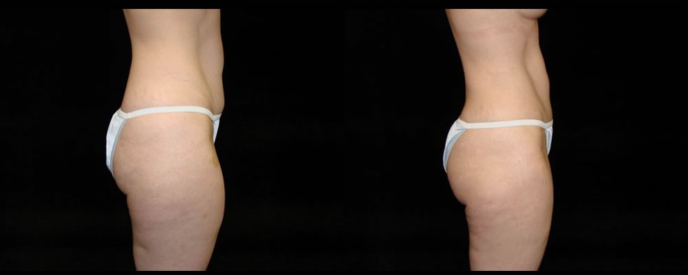 Tummy Tuck Before & After Patient #447