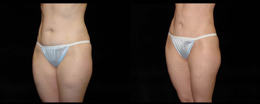 Tummy Tuck Before & After Patient #447