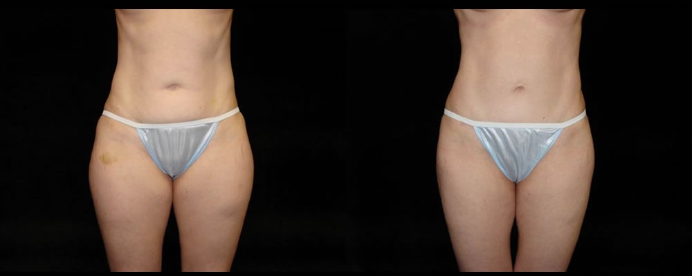 Tummy Tuck Before & After Patient #447