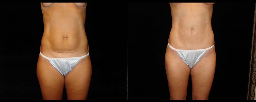 Tummy Tuck Before & After Patient #592