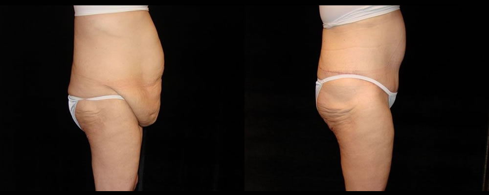 Tummy Tuck Before & After Patient #587