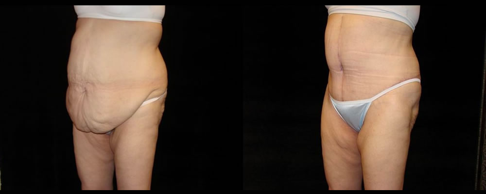 Tummy Tuck Before & After Patient #587