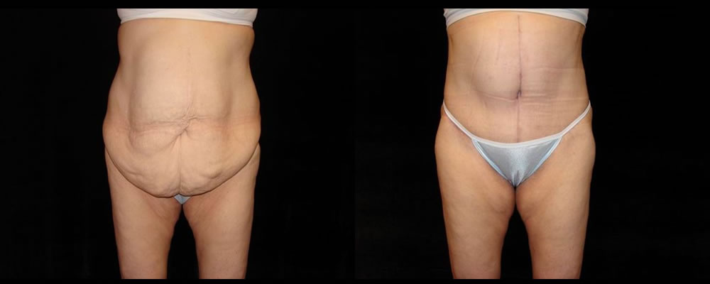 Tummy Tuck Before & After Patient #587