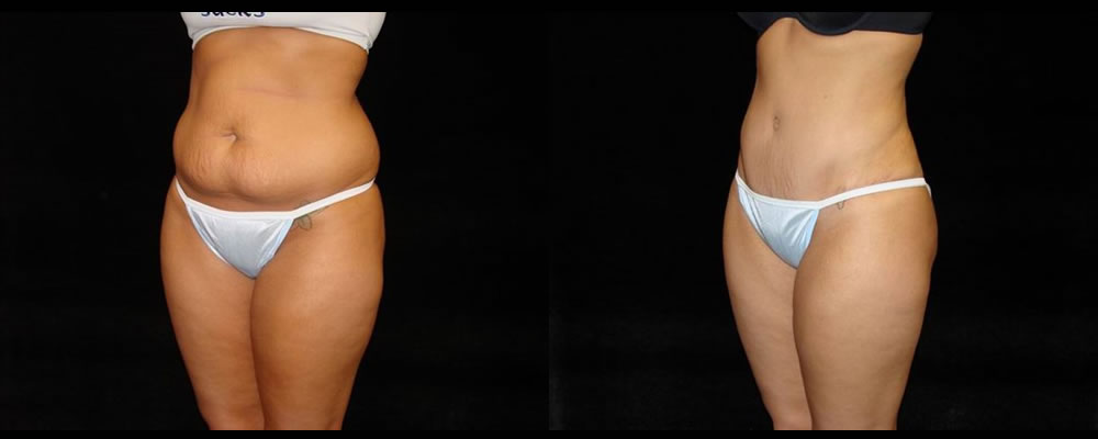 Tummy Tuck Before & After Patient #583