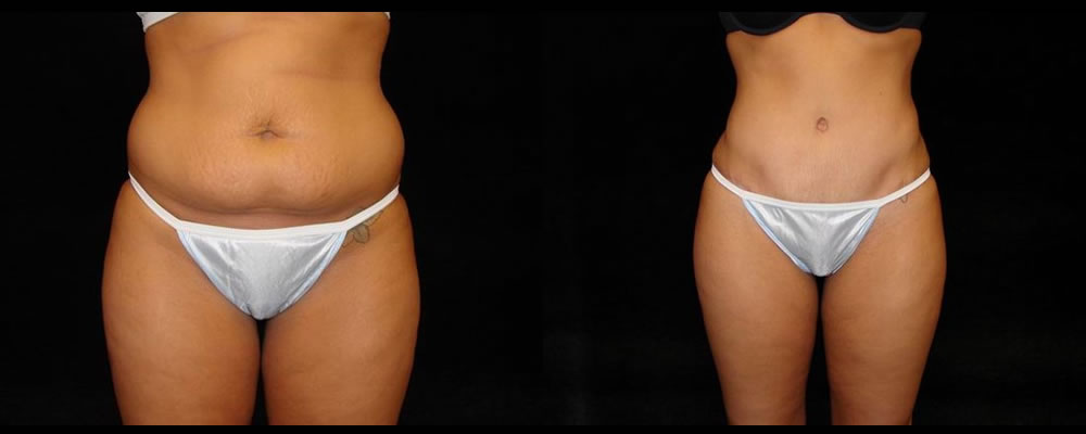 Tummy Tuck Before & After Patient #583