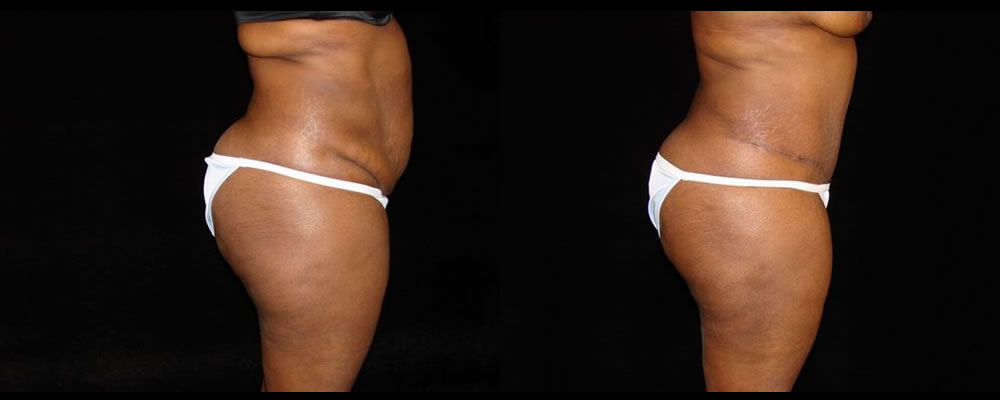 Tummy Tuck Before & After Patient #579
