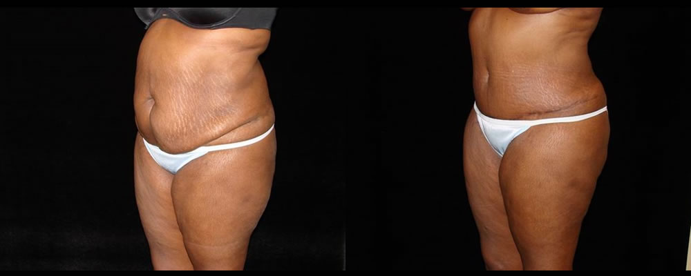 Tummy Tuck Before & After Patient #579