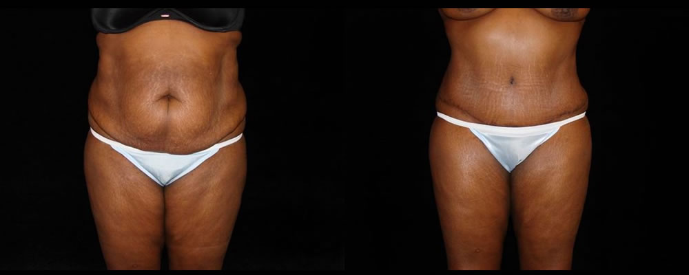 Tummy Tuck Before & After Patient #579