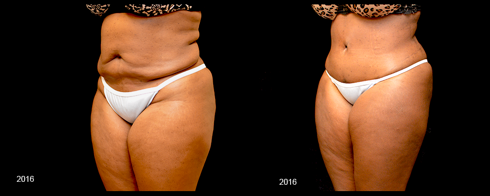 Tummy Tuck Before & After Patient #443