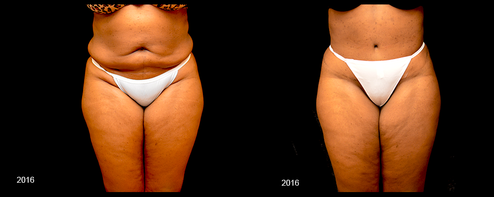 Tummy Tuck Before & After Patient #443