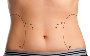 Tummy Tuck & Mini Tummy Tuck for Baltimore, Ellicott City