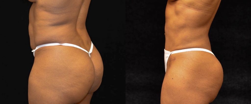 Tummy Tuck Before & After Patient #1837