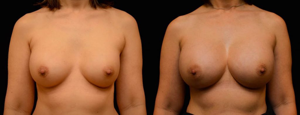 Breast Augmentation Before & After Patient #1842