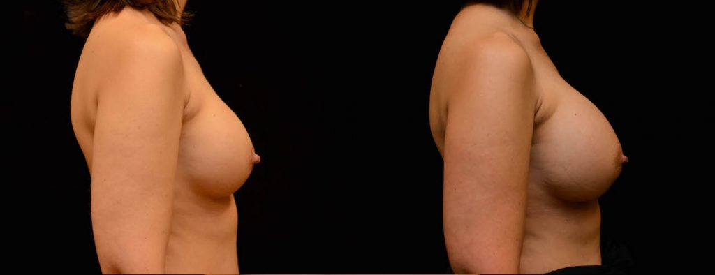 Breast Augmentation Before & After Patient #1842