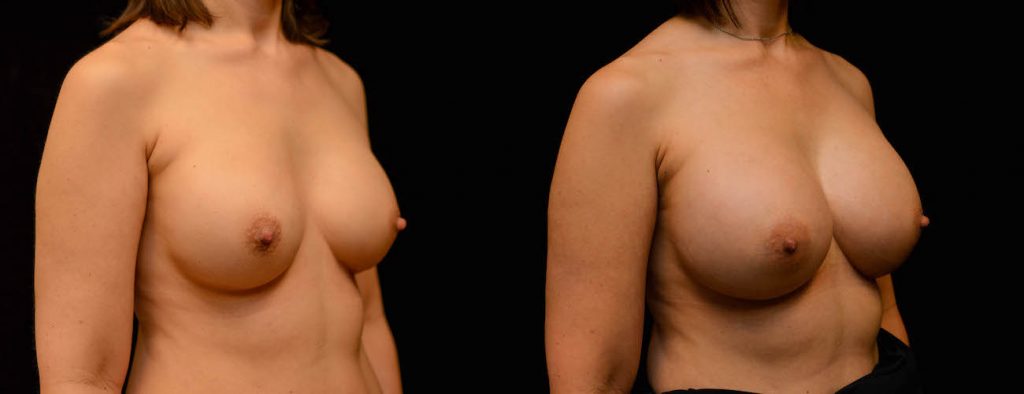 Breast Augmentation Before & After Patient #1842