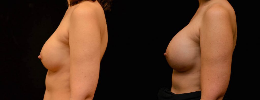 Breast Augmentation Before & After Patient #1842