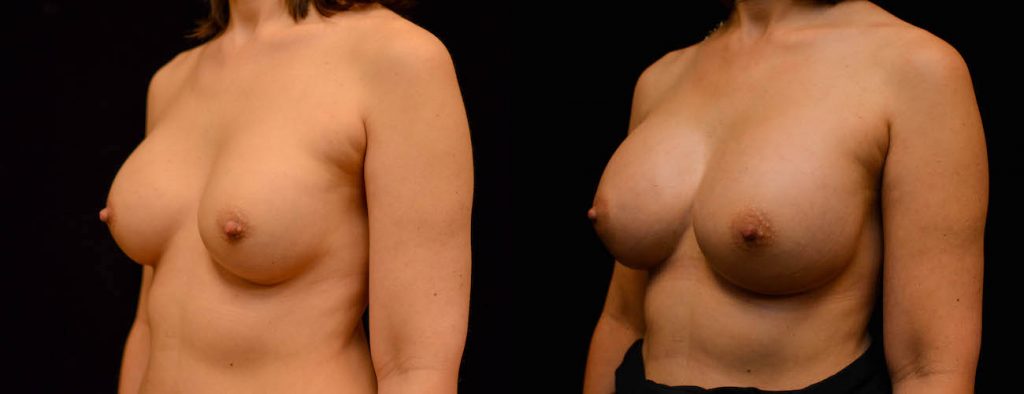 Breast Augmentation Before & After Patient #1842