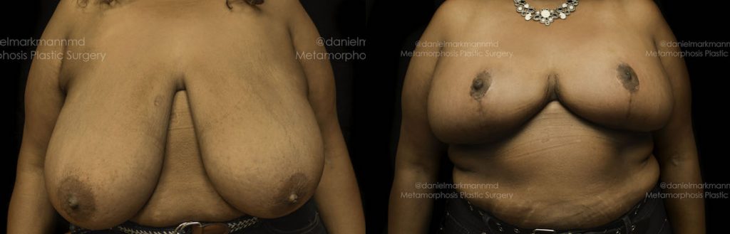 Breast Reduction Before & After Patient #1860