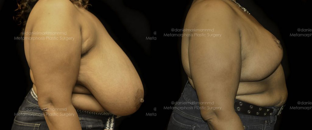 Breast Reduction Before & After Patient #1860