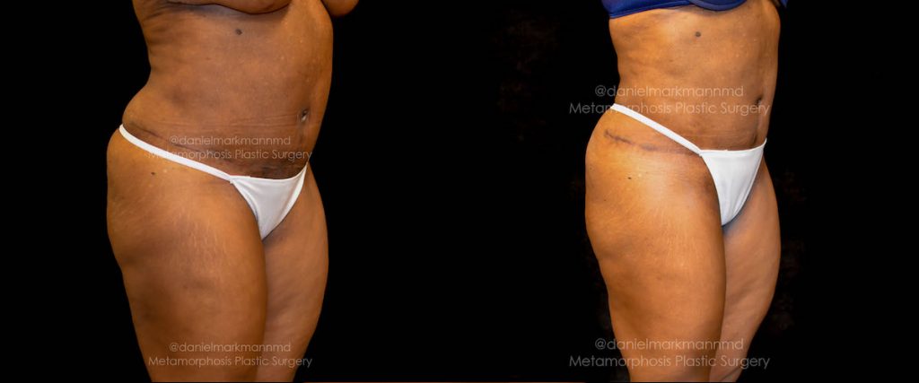 Mini Tummy Tuck Maryland, Baltimore