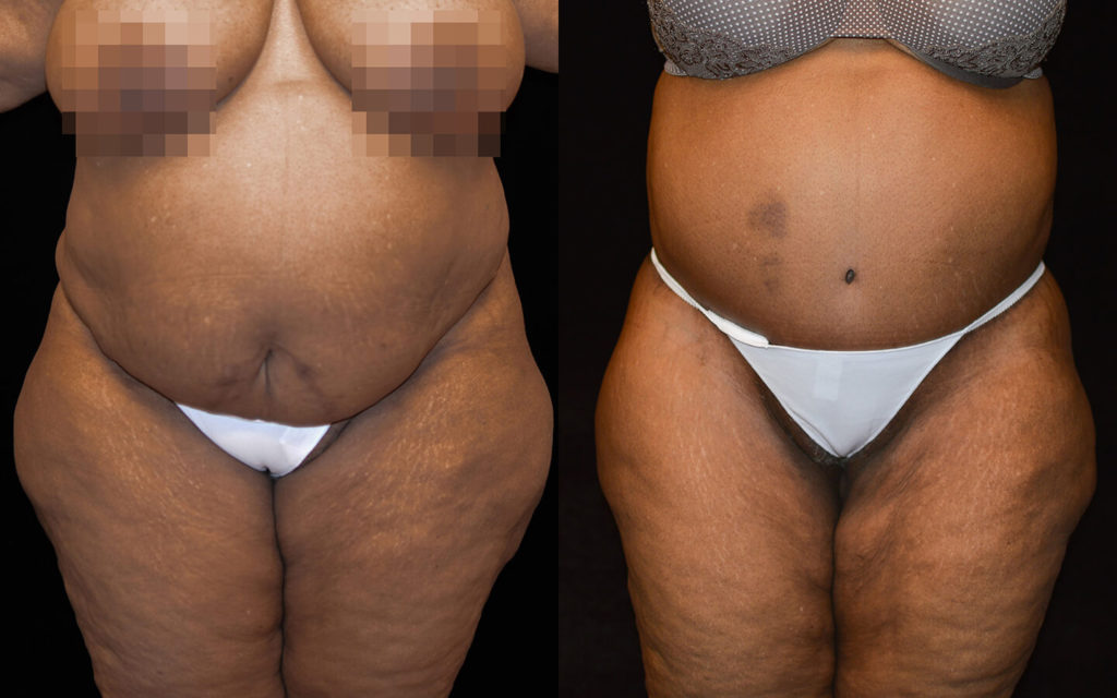 Tummy Tuck Before & After Patient #2095