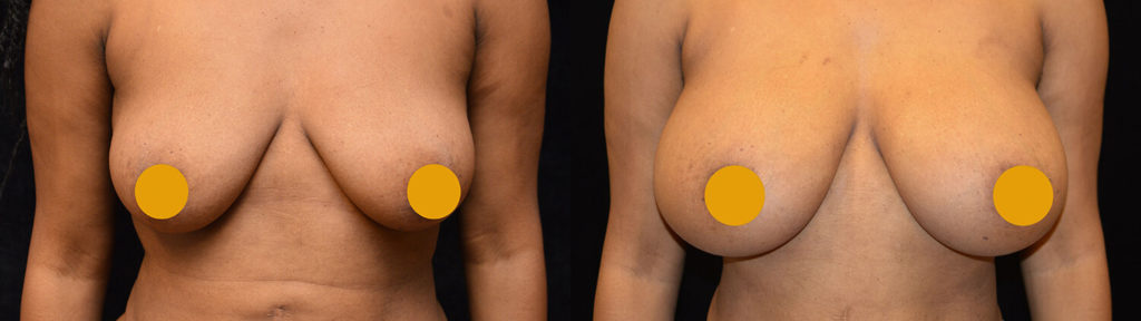 Breast Augmentation Before & After Patient #2108