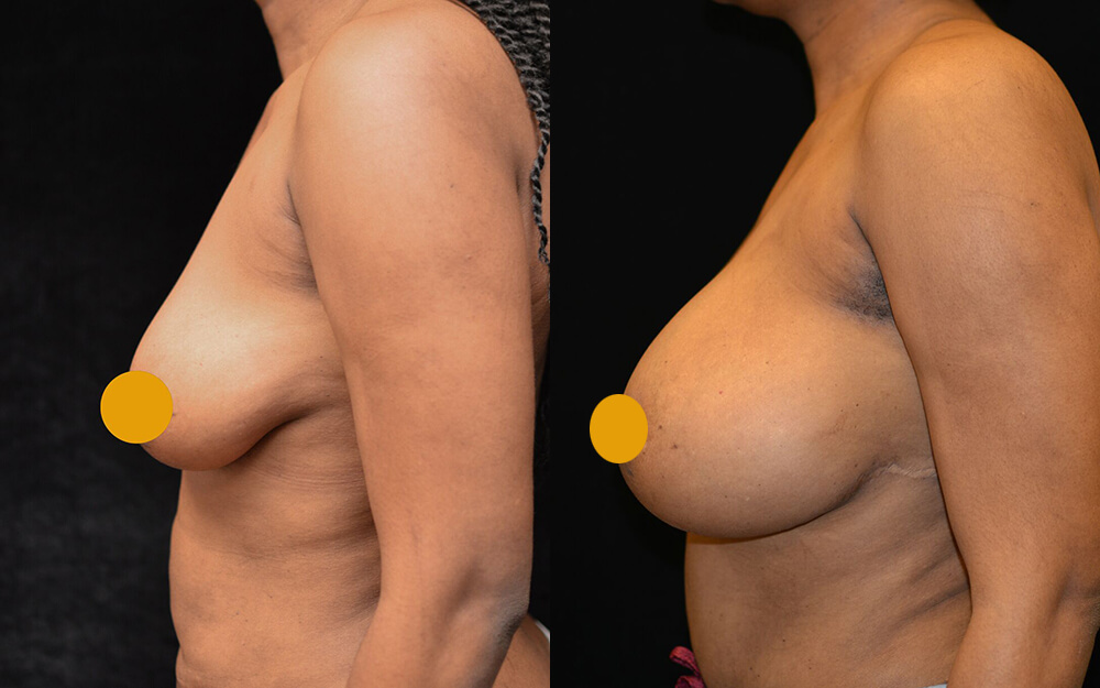 Breast Augmentation Before & After Patient #2108