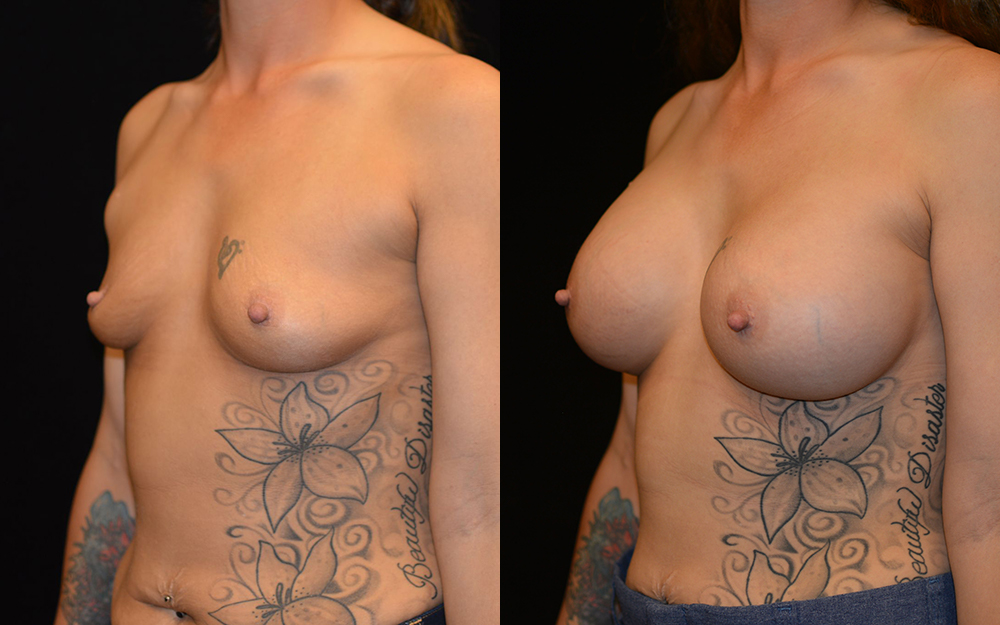 Breast Augmentation Before & After Patient #2111