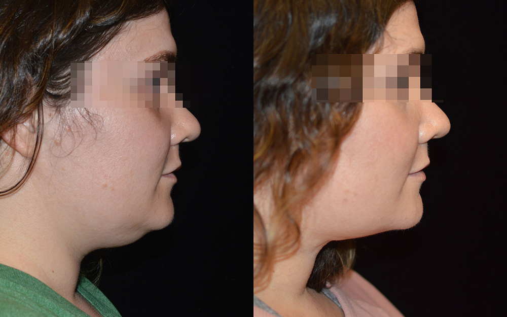 Chin Liposuction Before & After Patient #2114