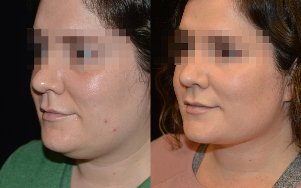 Chin Liposuction Before & After Patient #2114