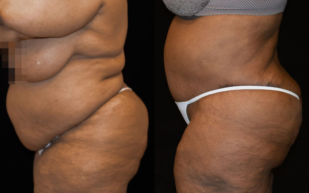 Tummy Tuck Before & After Patient #2095