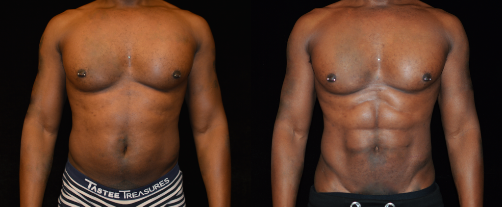 Abdominal Etching (Six Pack Abs) Maryland, Baltimore