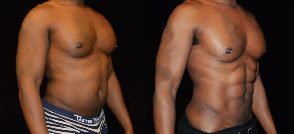 Man Shares Abdominal Etching Surgery Before and After Photos