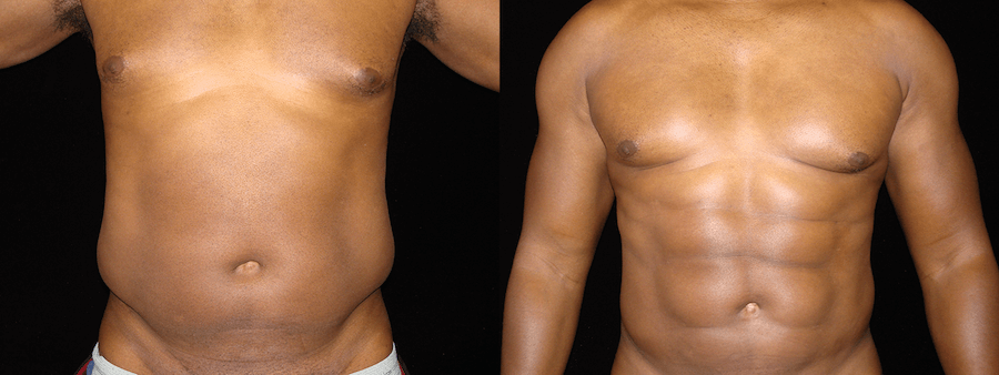 Six Pack Abs Before & After Patient #2129