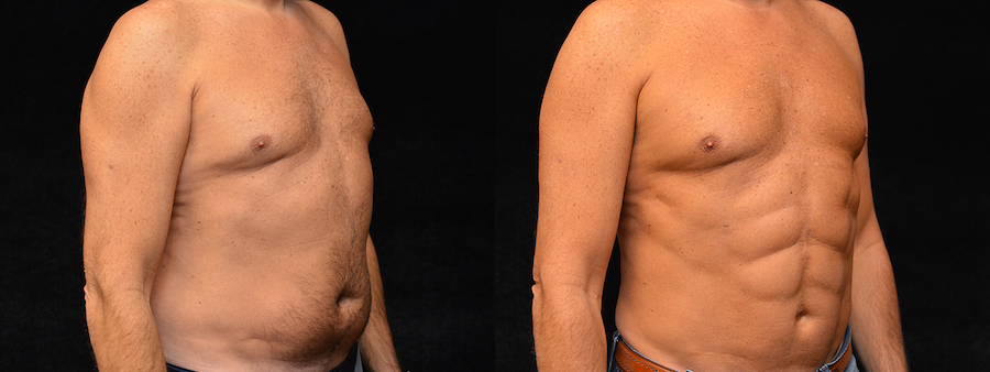 Six Pack Abs Before & After Patient #2135
