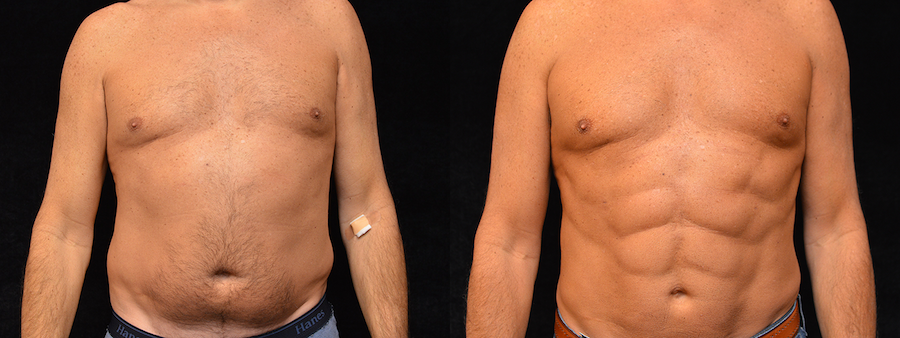 Six Pack Abs Before & After Patient #2135