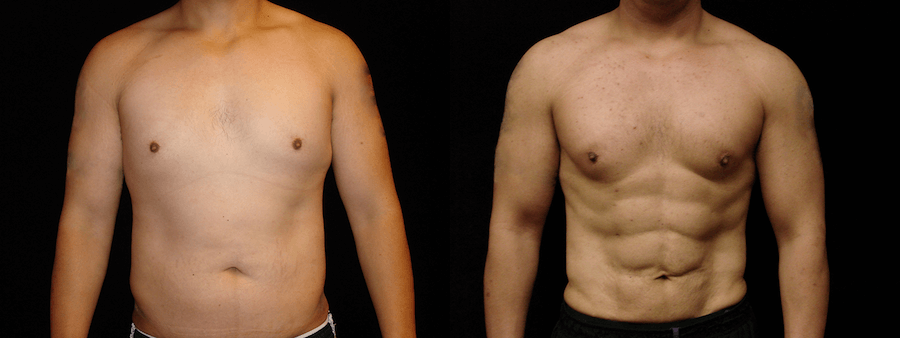 Are 6-pack Abs Possible after a Male Tummy Tuck? Yes, They Are! –  Aristocrat Plastic Surgery