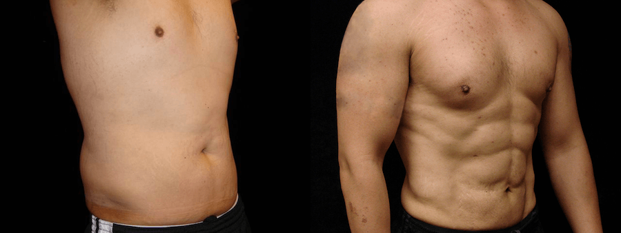 Six Pack Abs Before & After Patient #2139