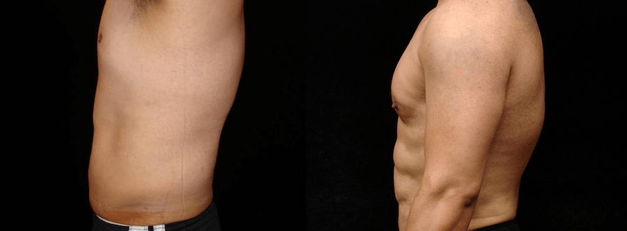 Six Pack Abs Before and After Photos Baltimore - Plastic Surgery Gallery  Columbia - Dr. Daniel Markmann