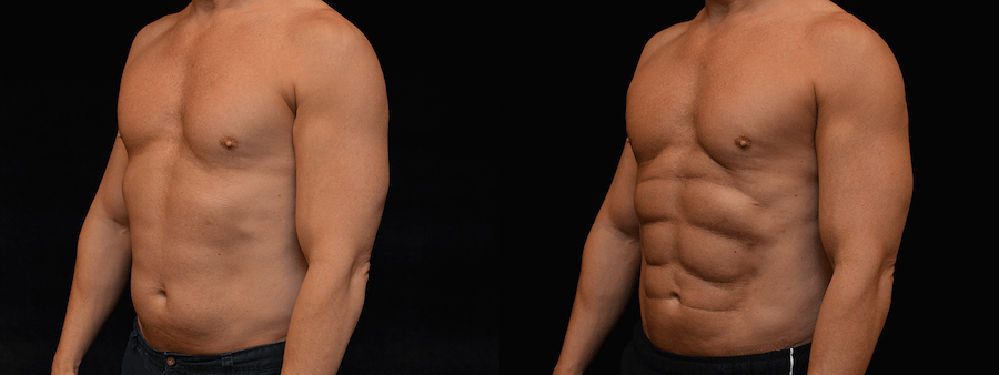 Six Pack Abs Before & After Patient #2143