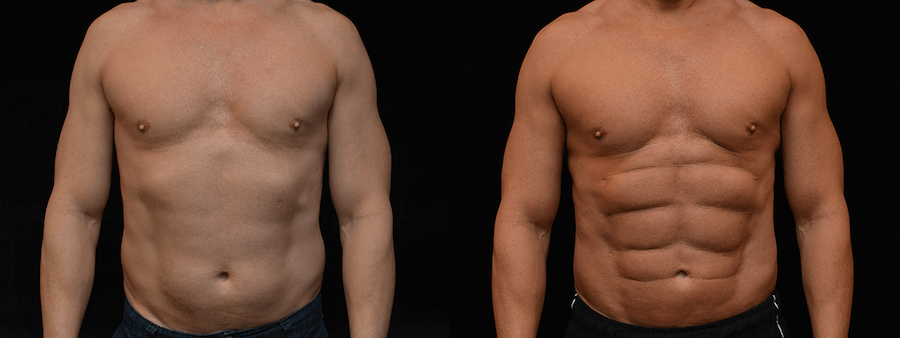 Six Pack Abs Before & After Patient #2143