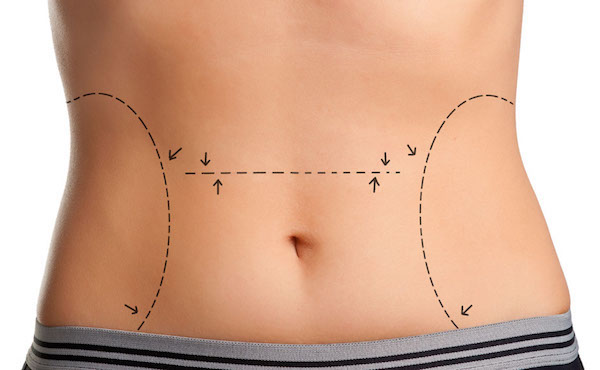 Tummy Tuck